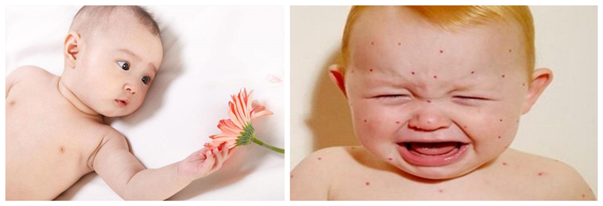 兒童濕疹反反復(fù)復(fù)，您有在家安裝家用除濕產(chǎn)品嗎？